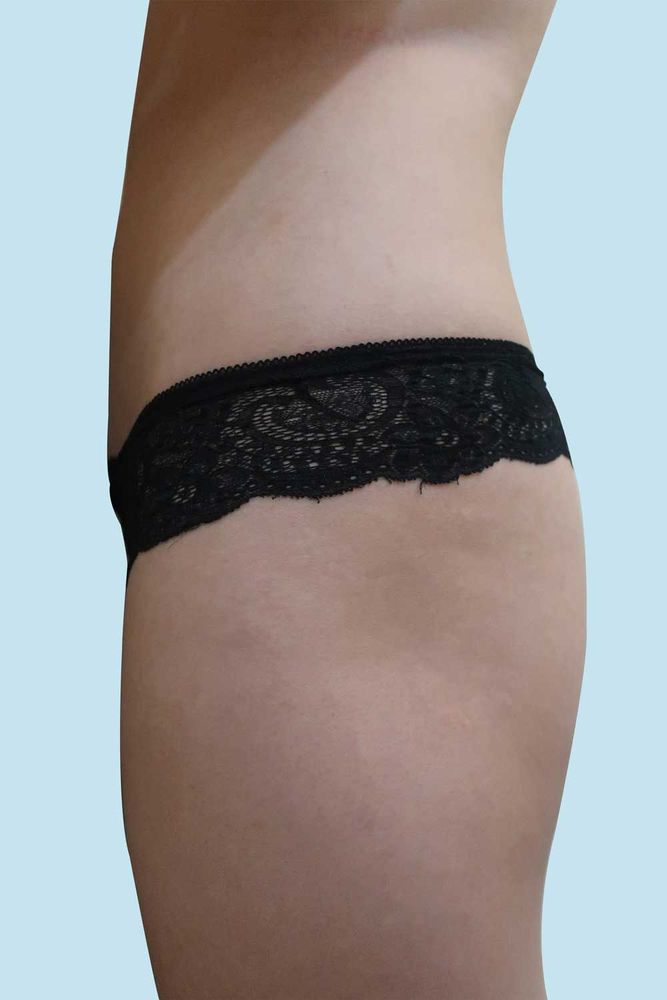 Hình ảnh khách hàng trước sau nâng mông nội soi và hút mỡ hông sau, sau 2 ngày phẫu thuật.
