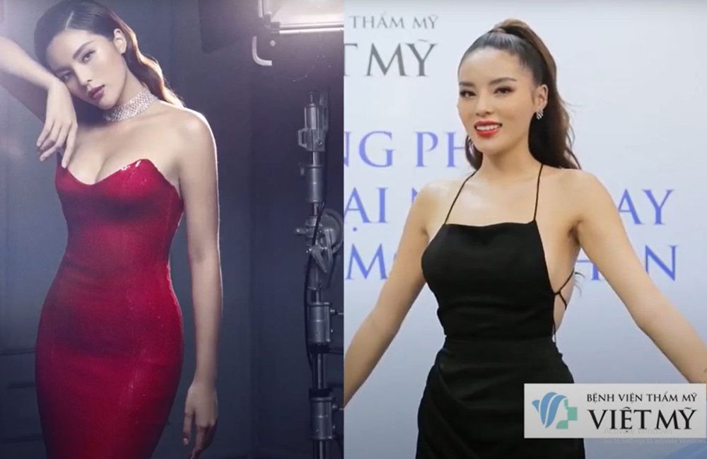 Hoa hậu Kỳ Duyên giảm mỡ 10kg bằng phương pháp hút mỡ bụng Liposonix.