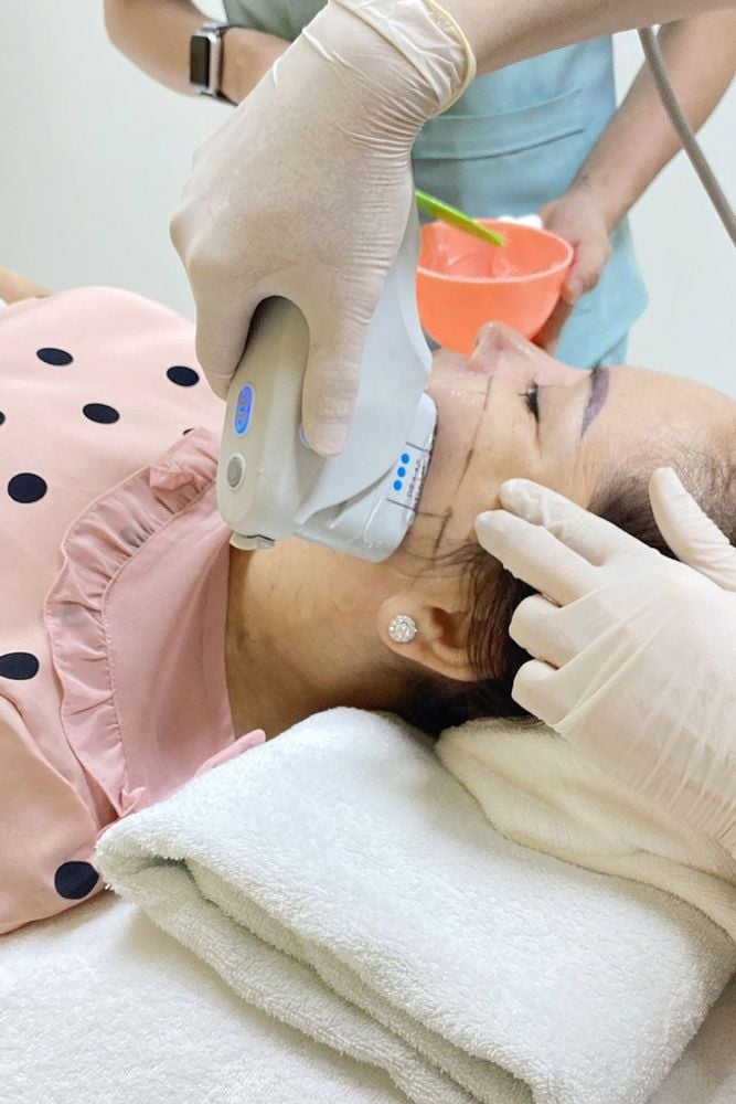 Ultherapy căng da mặt không phẫu thuật - Nâng Cơ Trẻ Hóa Da - bác sĩ Chiêm Quốc Thái