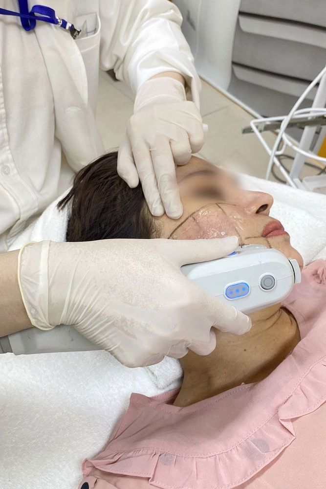 Ultherapy căng da mặt không phẫu thuật - Nâng Cơ Trẻ Hóa Da - bác sĩ Chiêm Quốc Thái