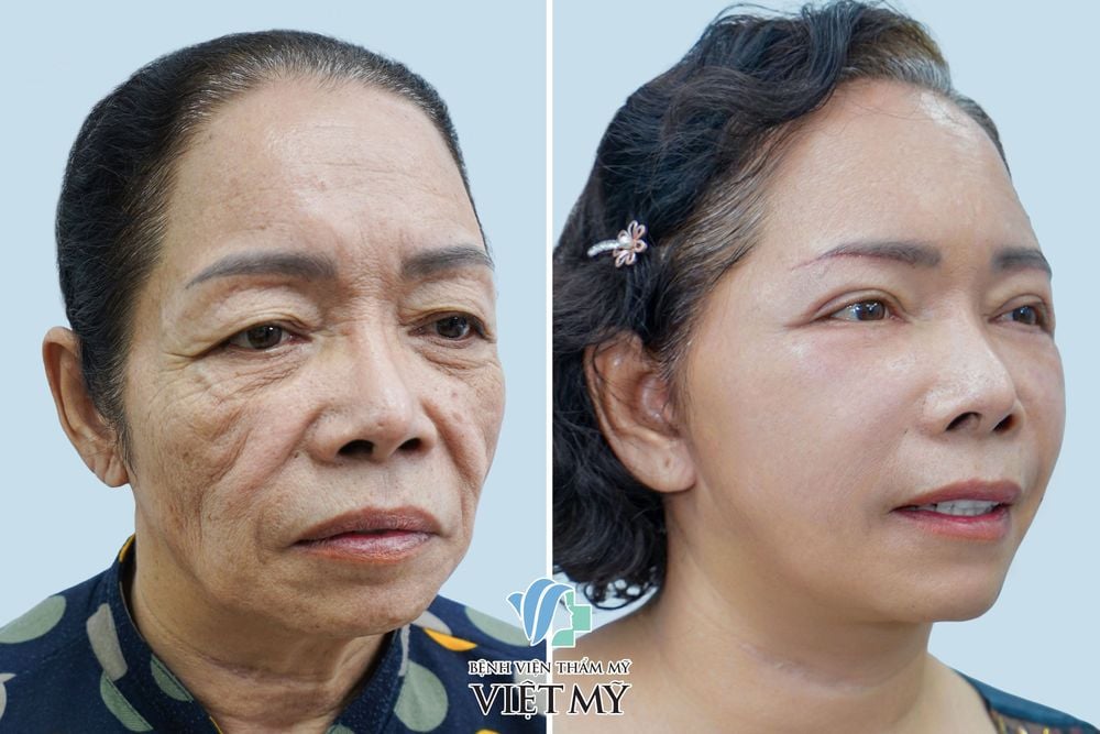 Khách hàng 70 tuổi làm đầy rãnh mũi má bằng mỡ tự thân, căng da mặt, treo chân mày, cắt mí dưới