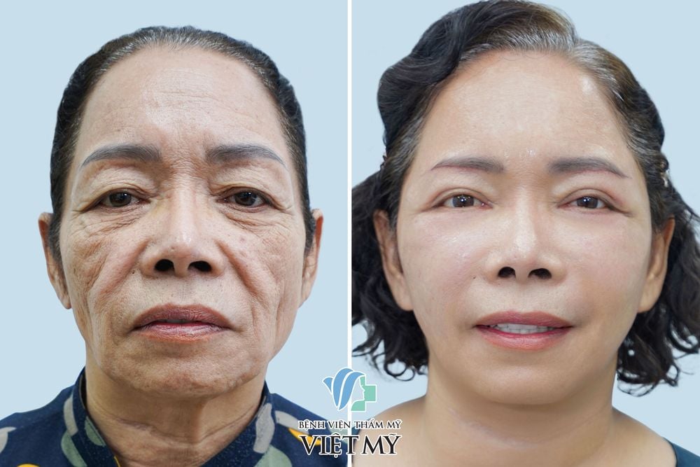 Khách hàng 70 tuổi làm đầy rãnh mũi má bằng mỡ tự thân, căng da mặt, treo chân mày, cắt mí dưới