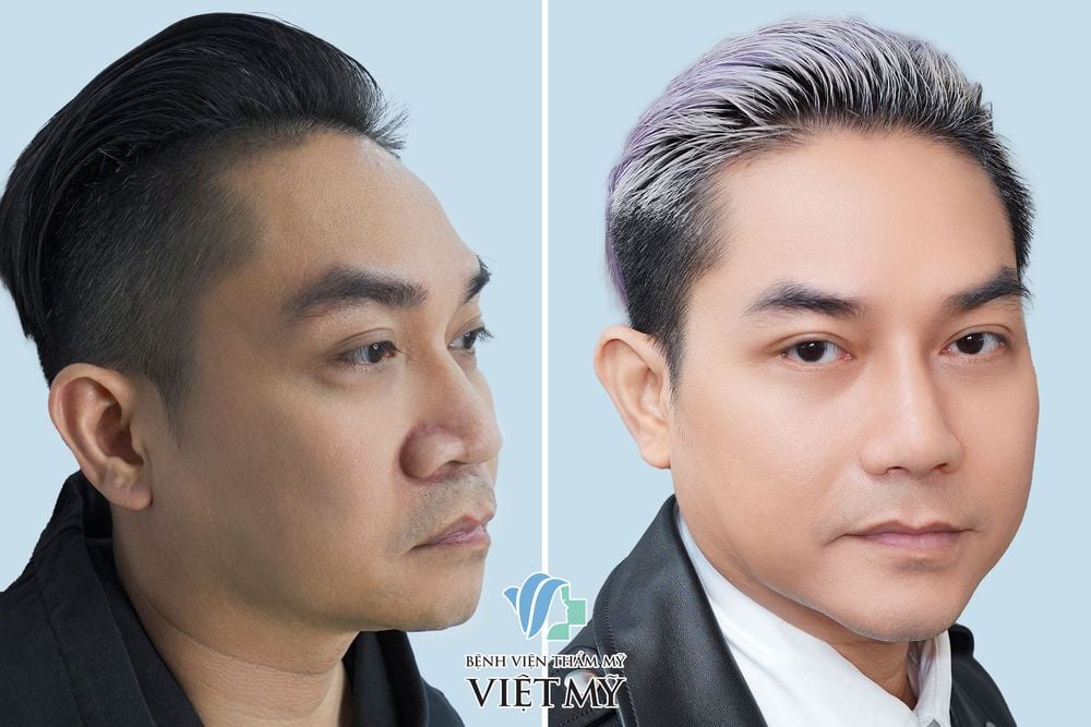 Ca sĩ Phạm Khánh Hưng trước và sau khi cắt mí dưới, nâng mũi, thu gọn cánh mũi và nâng cằm.