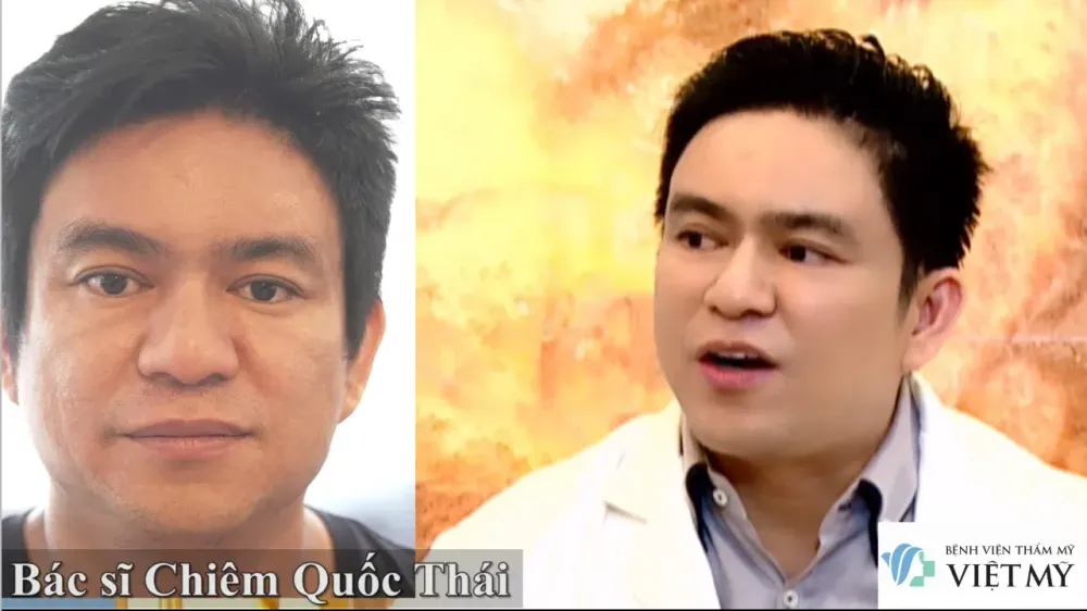 Bác sĩ Chiêm Quốc Thái trước và sau khi được bác sĩ bệnh viện thẩm mỹ Việt Mỹ, căng da mặt bằng chỉ Collagen.