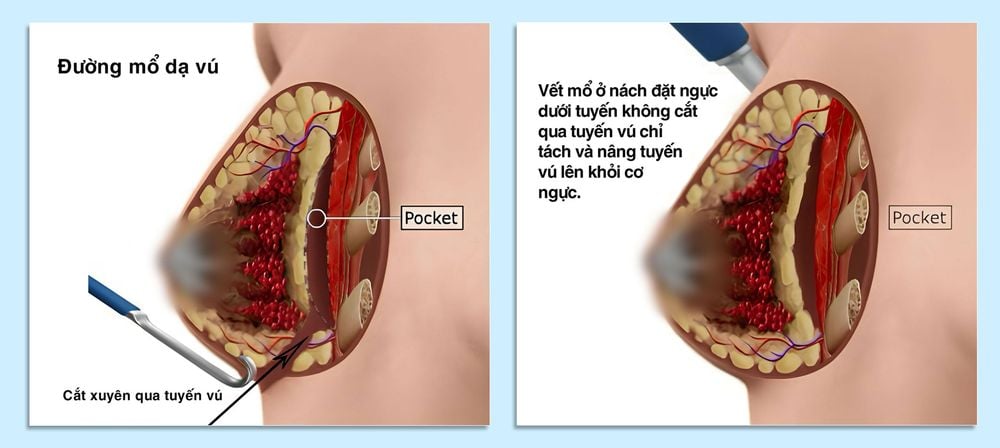 Hình ảnh đặt túi ngực dưới tuyến, đường dạ vú và quầng vú.