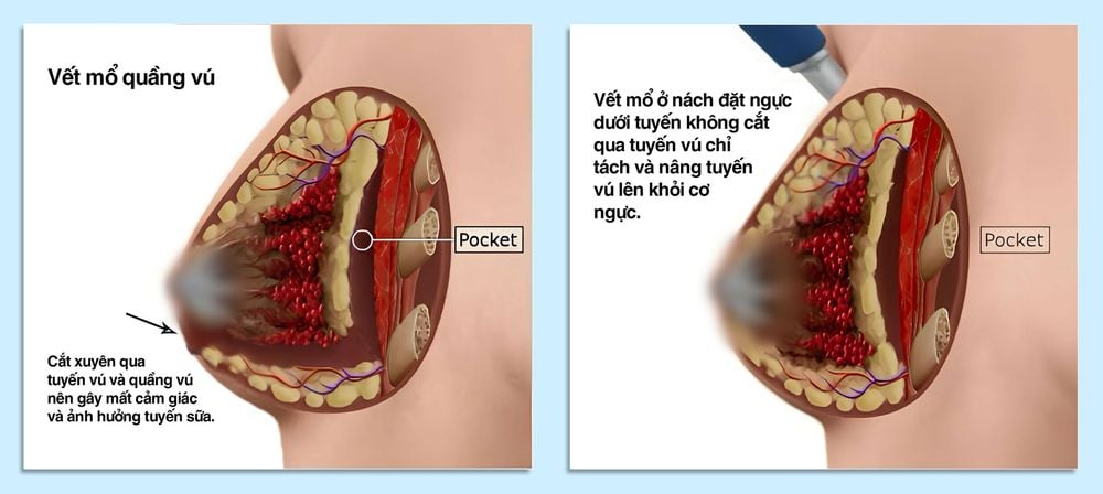 Hình ảnh đặt túi ngực dưới tuyến đường nách và quầng vú