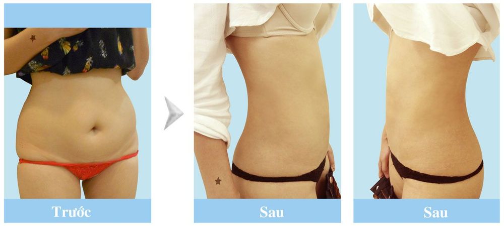 Hình ảnh khách hàng trước và sau hút mỡ
