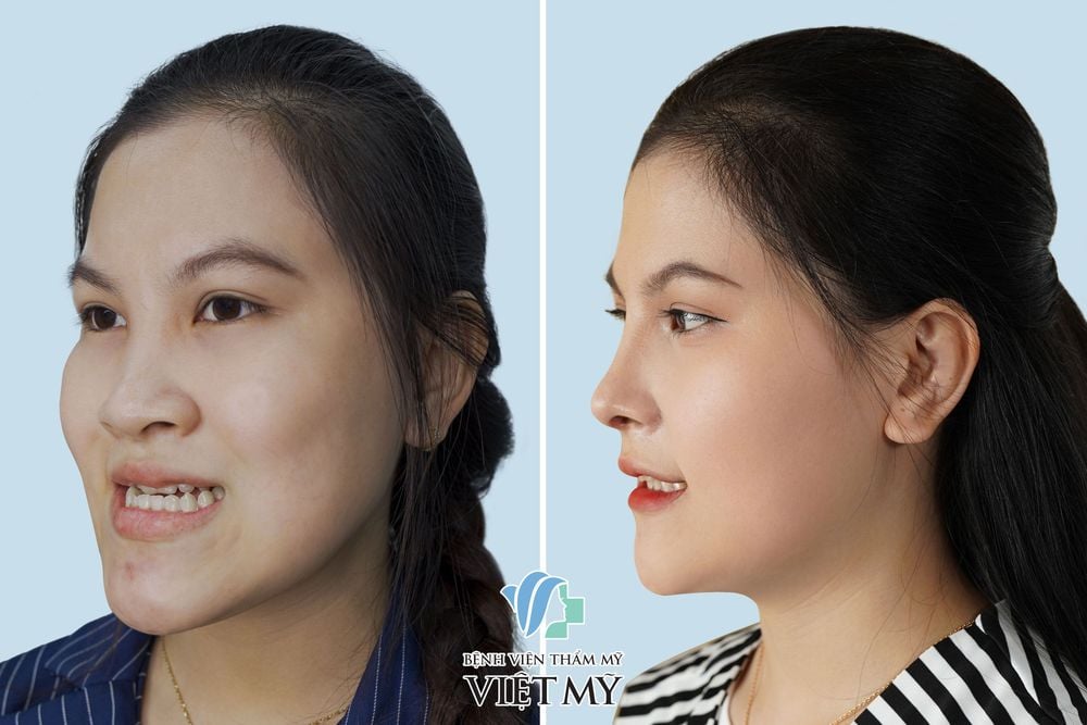 Khách hàng trước và sau trượt cằm, tạo hình hàm móm