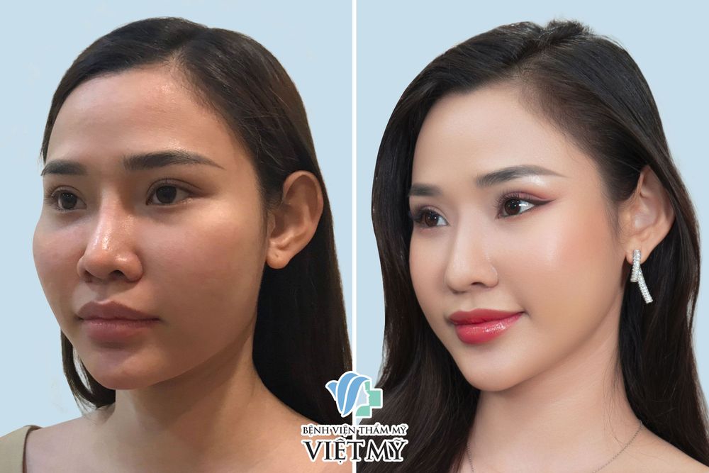 Khách hàng trước và sau nâng mũi, nâng cằm, hạ gò má