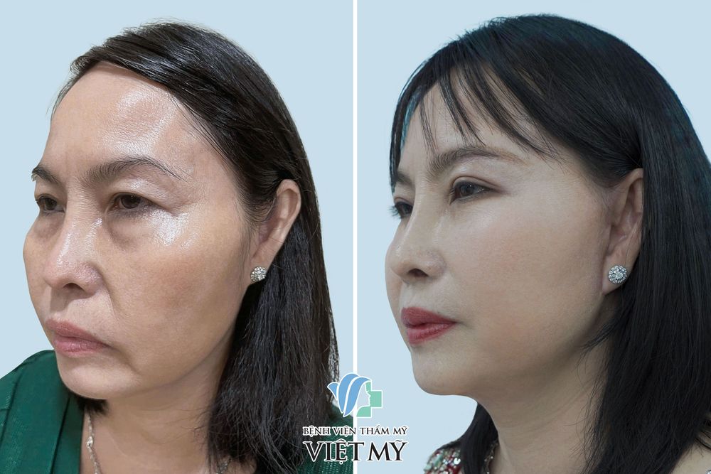 Khách hàng U60 căng da mặt nội soi, treo chân mày, cắt mí dưới, hạ đường chân tóc.