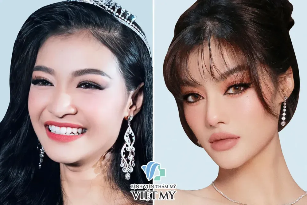 Á hậu Kiều Loan nâng mũi và phẫu thuật thẩm mỹ toàn diện.