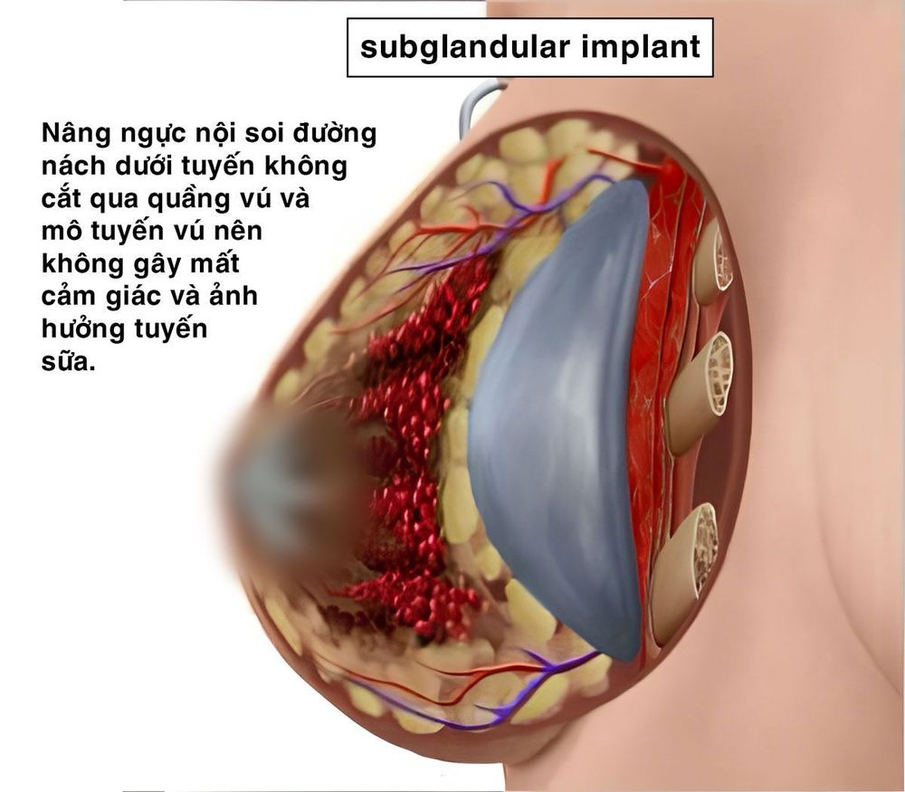 Nâng ngực nội soi đường nách đặt dưới tuyến