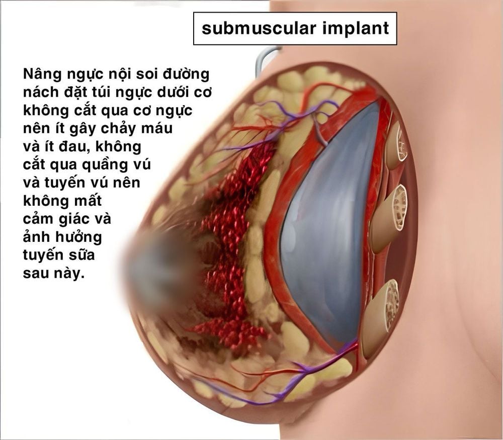 Hình ảnh đặt túi ngực dưới cơ.