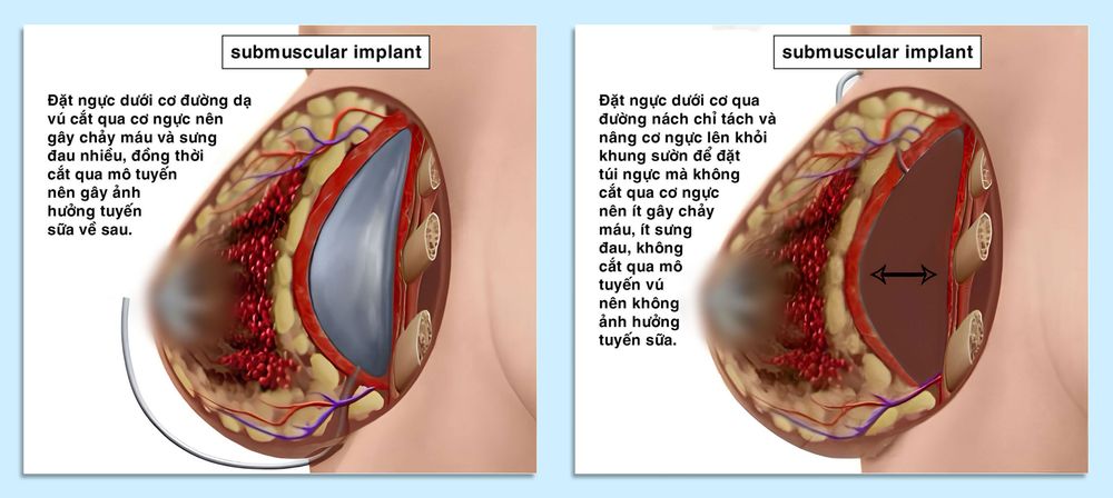 Nâng ngực mổ hở nếp dạ vú