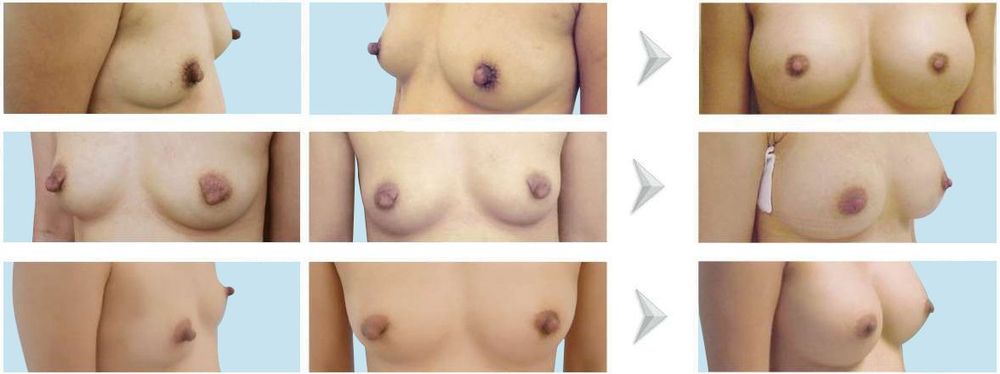 Hình ảnh trước và sau thu nhỏ đầu ngực