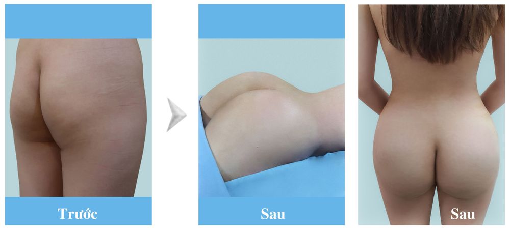 Hình ảnh trước / sau khách hàng nữ 32 tuổi hút mỡ - nâng mông mỡ tự thân