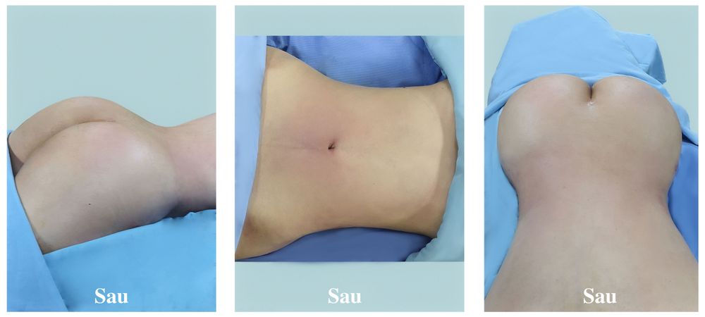 Hình ảnh trước / sau khách hàng nữ 32 tuổi hút mỡ - nâng mông mỡ tự thân