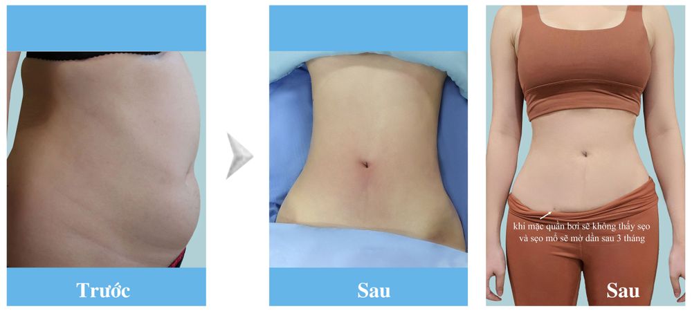 Hình ảnh trước sau hút mỡ nâng mông mỡ tự thân