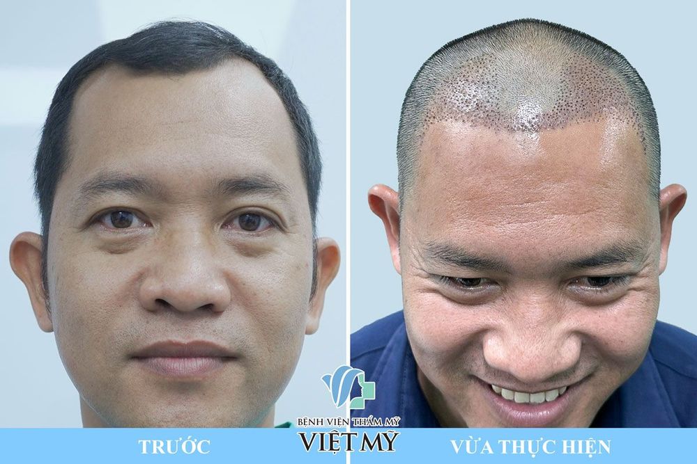 Cấy tóc DHI (FUE) – Cấy tóc trực tiếp
