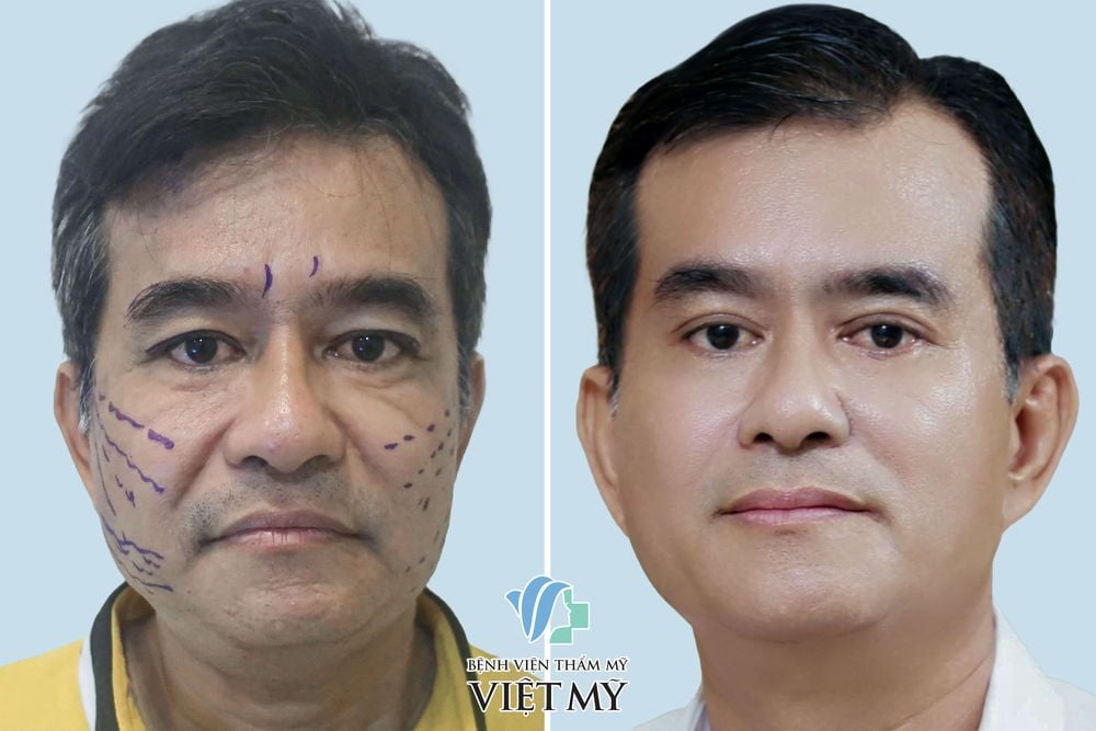 Khách hàng 60 tuổi căng da mặt chỉ cắt mắt 2 mí, cắt mí dưới và làm đầy rãnh mũi má bằng mỡ tự thân.