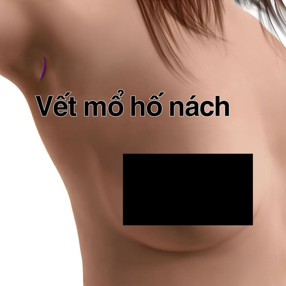 Vết mổ hố nách