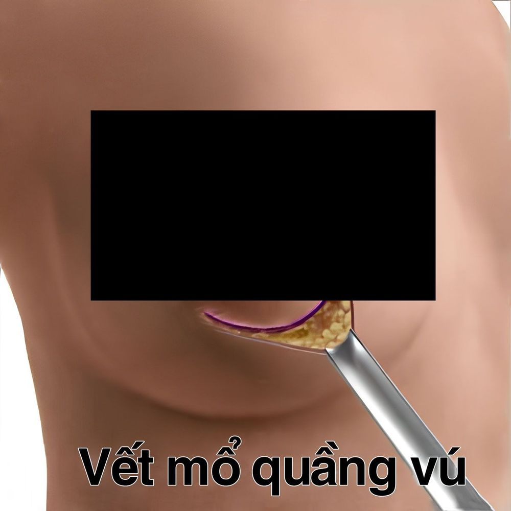 vết mổ quầng vú