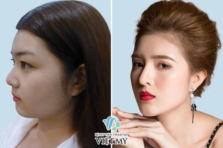 Lily Luta nâng mũi hàn quốc S line