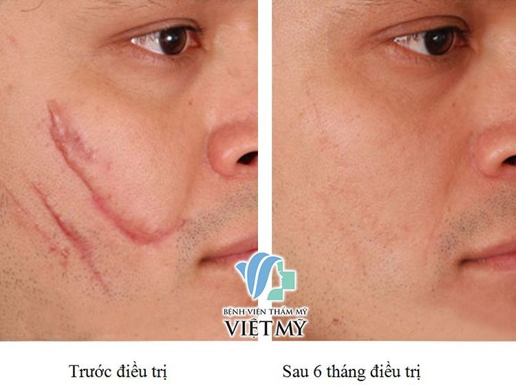 Điều Trị Mụn, Sẹo Xấu, Rạn Da Bằng Laser