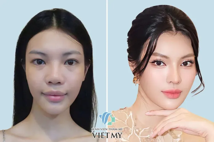 Á hậu chuyển giới Tường San trước và sau phẫu thuật thẩm mỹ