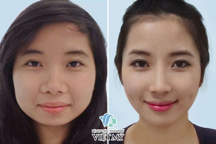Nâng cằm, phẫu thuật cắt mắt, nâng mũi, thon gọn mặt, tạo hình môi.