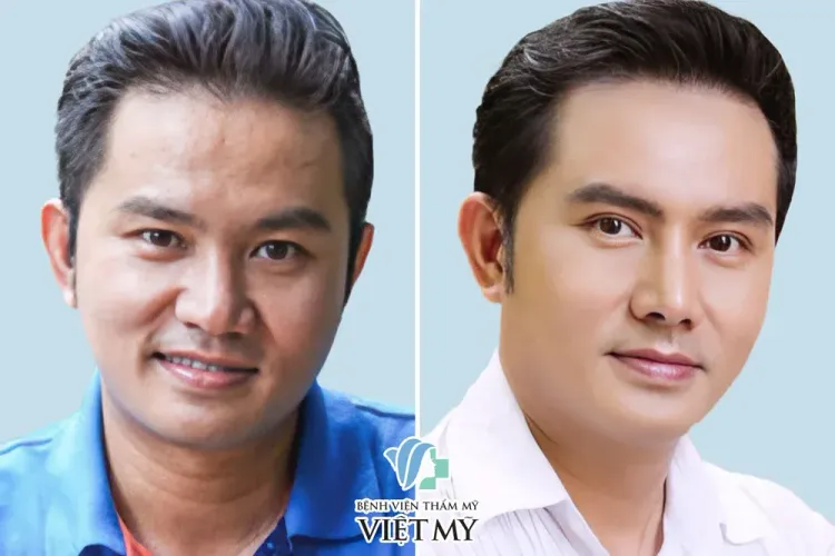 Diễn viên Thiên Bảo trước và sau phẫu thuật mũi, thu gọn cánh mũi, cắt mắt