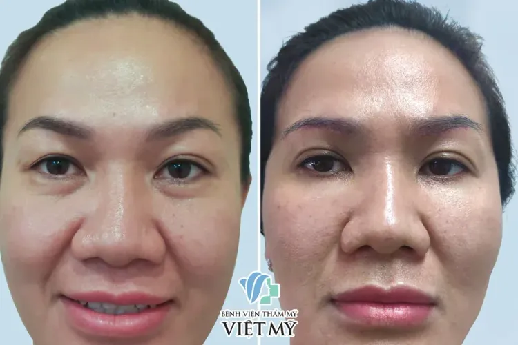 Treo chân mày và cắt mí dưới sau 5 ngày cắt chỉ.
