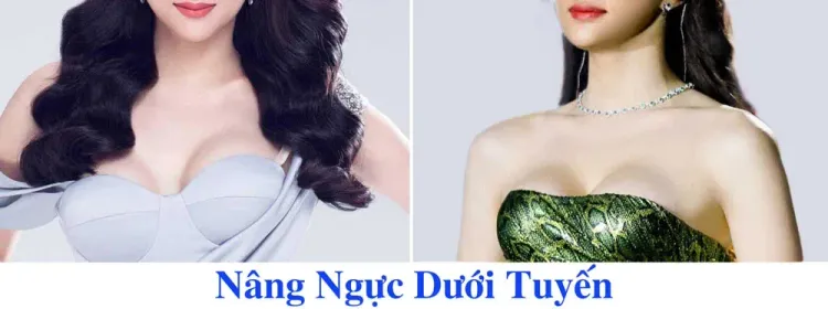 Hoa hậu Hương Giang nâng ngực dưới tuyến tại Thái Lan