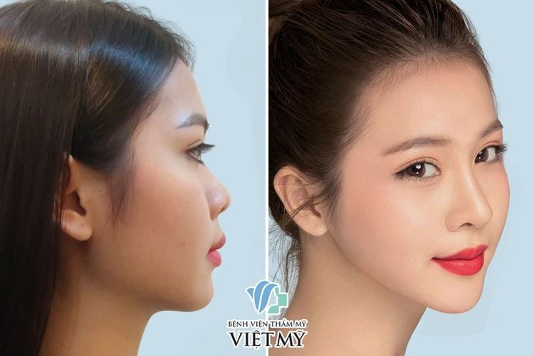 Hoa hậu Kim Ngọc trước và sau khi làm mũi và phẫu thuật thẩm mỹ toàn diện
