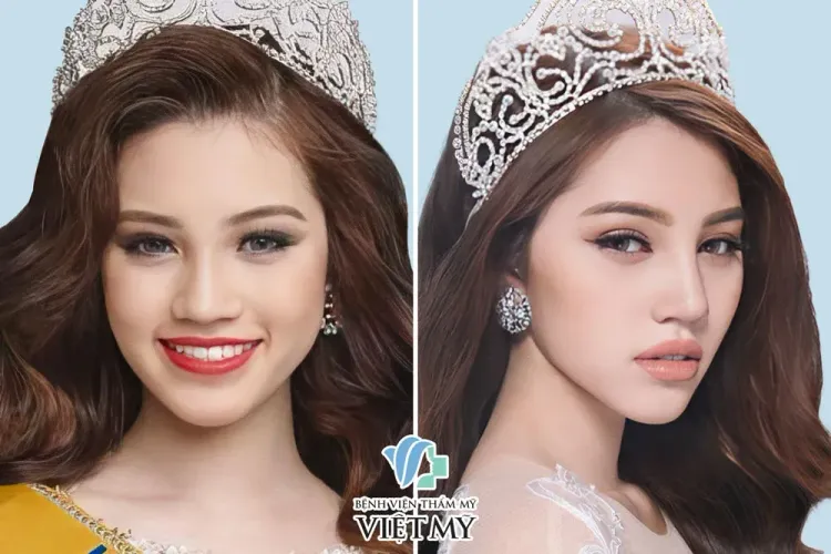 Jolie Nguyễn sau phẫu thuật thẩm mỹ toàn diện.