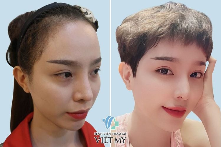 Bơm mỡ hõm thái dương, vùng má, khuyết mí dưới sau 1 tháng.