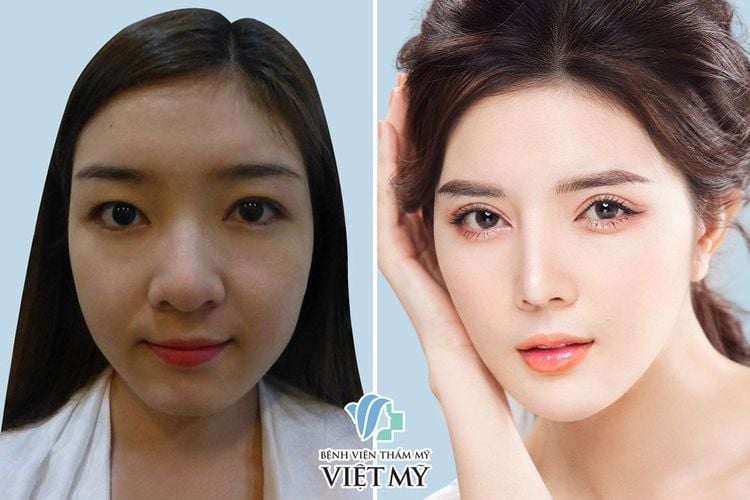 lily luta phẫu thuật thẩm mỹ