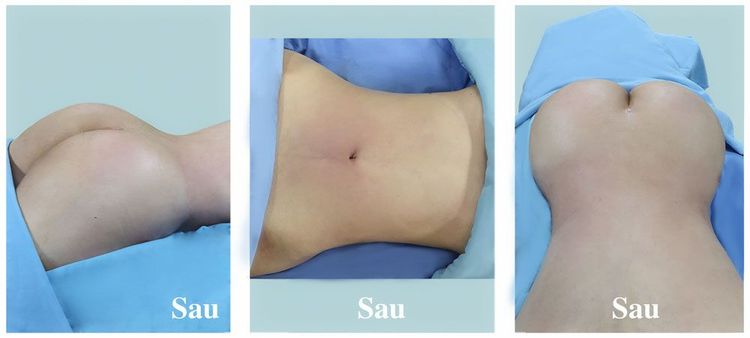 Hình ảnh trước / sau khách hàng nữ 32 tuổi hút mỡ - nâng mông mỡ tự thân