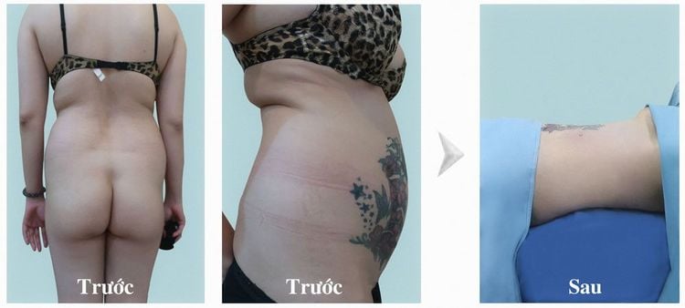 Khách hàng nữ 45 tuổi hút mỡ và nâng mông mỡ tự thân.