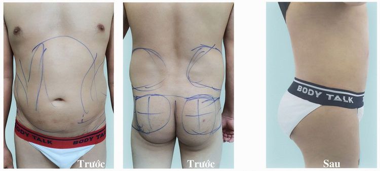 Khách hàng nam 40 tuổi hút mỡ - bơm mông mỡ tự thân.
