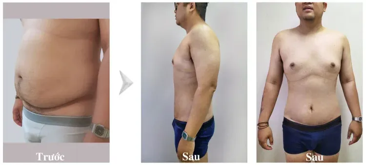 Khách hàng vừa hút mỡ, căng da bụng sau 7 ngày và sẽ cắt chỉ sau 10 ngày.