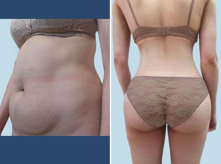 Hình ảnh trước/sau của khách hàng hút mỡ bụng Lipo Ultrasound và bơm mỡ tự thân vào mông