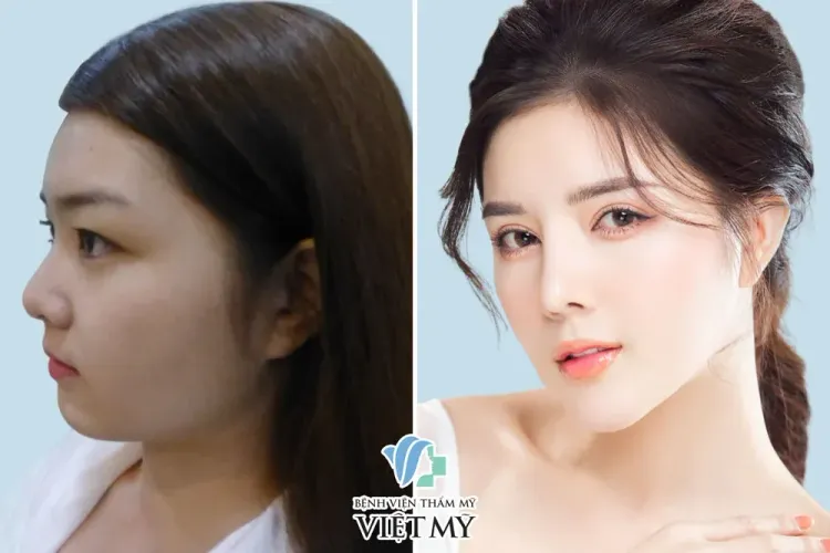 Lily Luta nâng mũi, thu gọn cánh mũi, nâng cằm, cắt mắt, gọt góc hàm