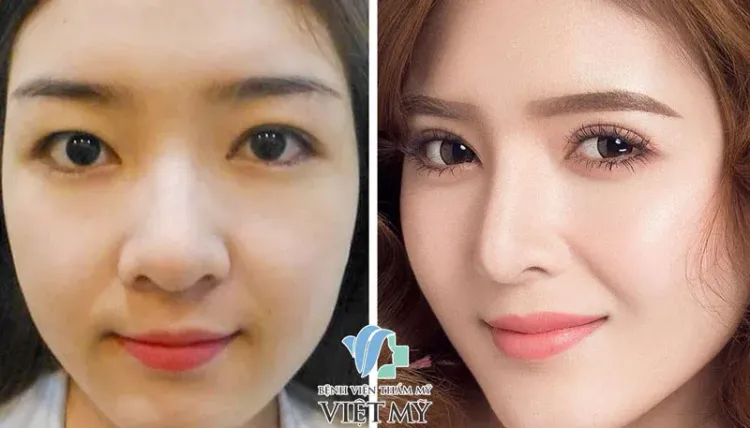 Lily Luta cắt mắt và phẫu thuật thẩm mỹ toàn diện.
