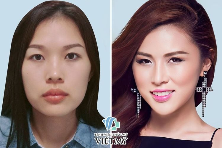 Miss Bikini Kim Yến trước và sau khi đặt mũi, nâng cằm và phẫu thuật thẩm mỹ toàn diện