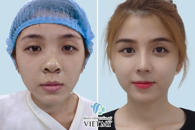 Khách hàng thực hiện phẫu thuật mũi, thu gọn cánh mũi.