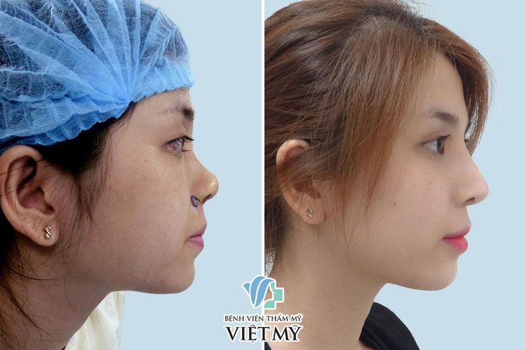 Khách hàng thực hiện phẫu thuật mũi, thu gọn cánh mũi.