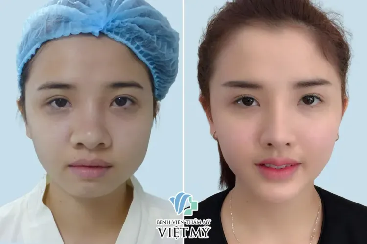 Hình ảnh trước và sau nâng mũi cấu trúc s Line, thu gọn cánh mũi - Độn cằm V Line.
