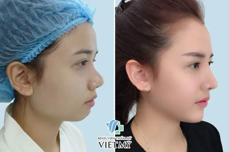 Hình ảnh trước và sau nâng mũi cấu trúc s Line, thu gọn cánh mũi - Độn cằm V Line.