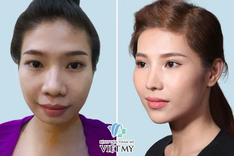nâng mũi cấu trúc, thu gọn cánh mũi, nâng cằm, cắt mắt.